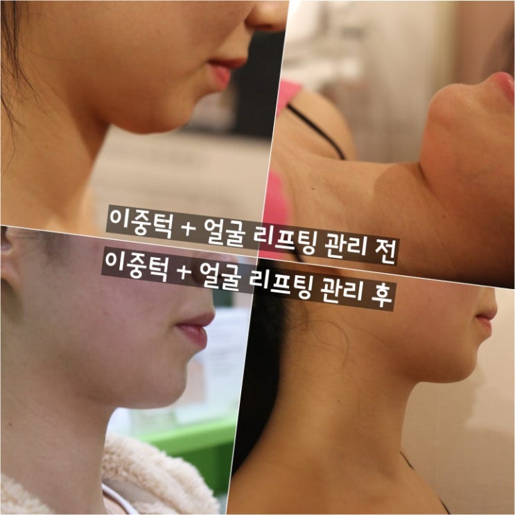  천안피부관리 두정동 목주름과 얼굴리프팅 이중턱관리 신부동 피부관리 회원님 포스팅 링크