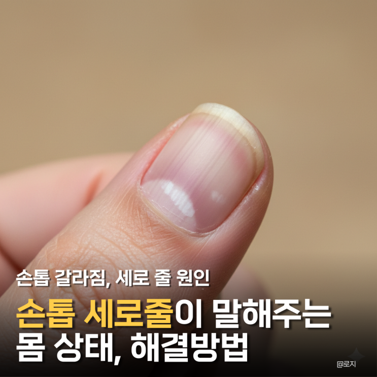  손톱 세로줄의 충격적인 원인 해결방법