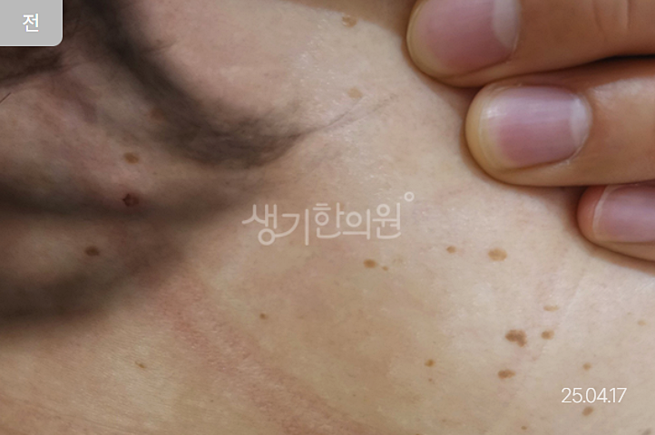 편평사마귀 식초 민간요법, '이것' 모르고 하면 큰일 납니다.