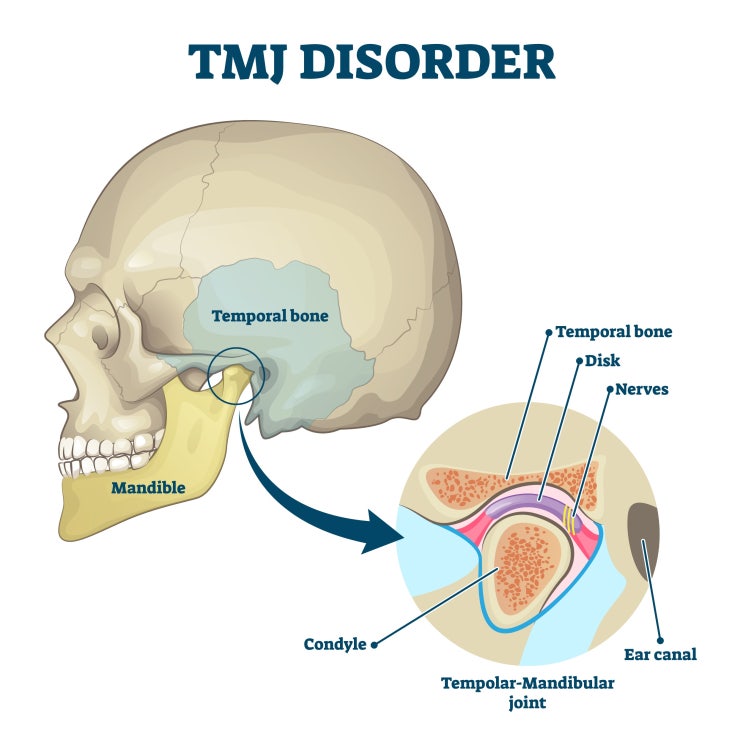  어금니 압하로 교합평면(occlusal plane)의 변화가 턱관리에 주는 영향, 턱관절 소리와 통증, 얼굴형과 '교합평면'에 답이 있습니다 (feat. 구치부 압하의 양면성)