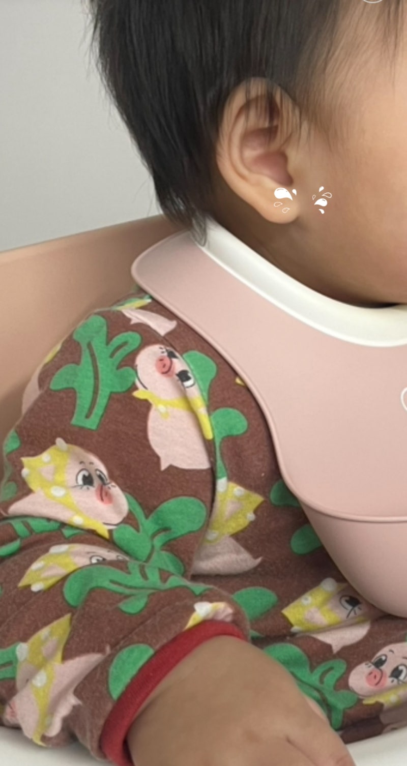 아기 피지낭종 모기질종 아주대병원 회송 성형외과 수술 후기 보험 코드