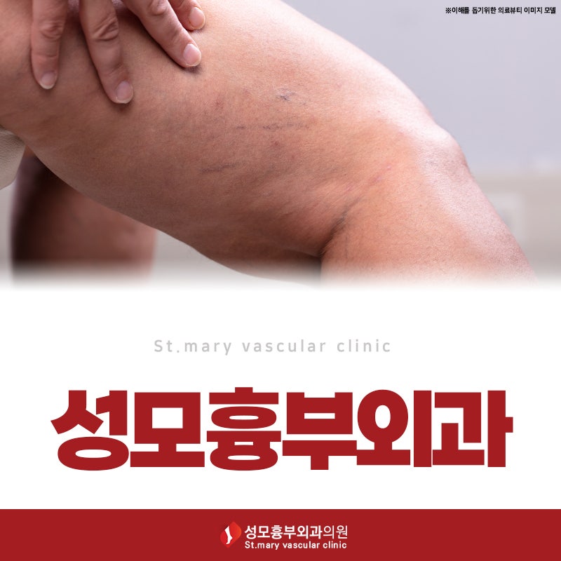 청주하지정맥류 혈관부종원인 검사 필요한 이유