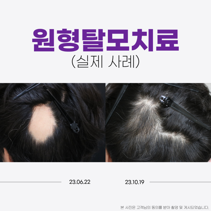 일산원형탈모병원 원인부터 탈모치료까지, 계속 재발하는 이유는?