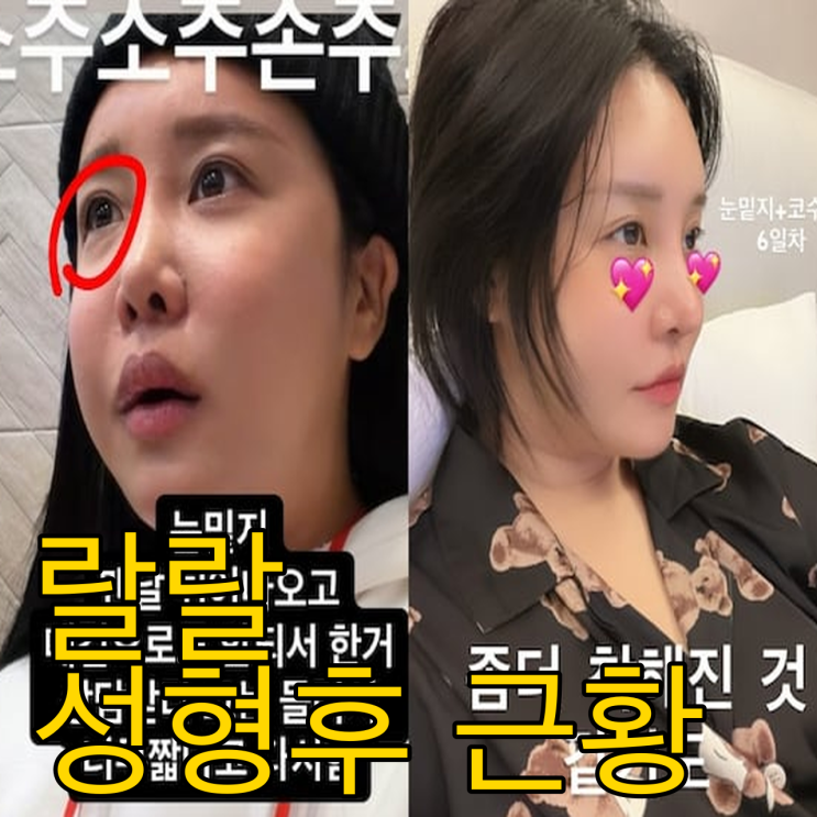  랄랄 성형 고백! 눈밑지 코수술 후 확 바뀐 미모