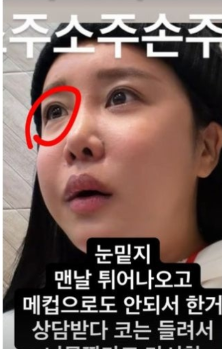 랄랄 성형 병원정보 공개 얼굴 눈밑지 코 싹 뜯어고쳐 붓기빠진 근황