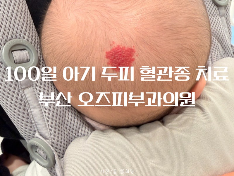 100일 여자 아기 두피 혈관종 부산 오즈피부과의원