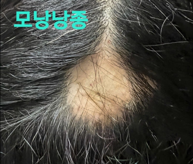 머리에 혹. 두피피지 낭종. 모낭 낭종. 지방종