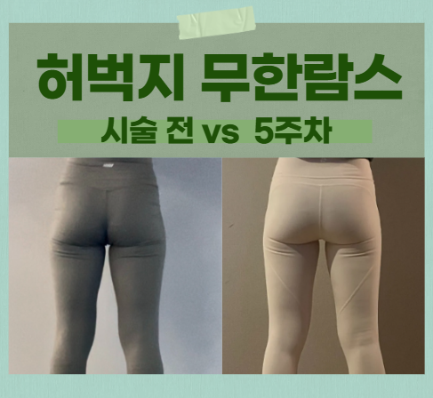  혜화 허벅지 무한람스 5주 차 솔직후기! : 정체기인가요..? 관리에 집중하는 요즘!