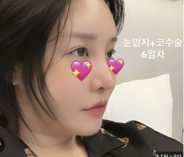 랄랄 성형 수술 후 파격 근황 공개 눈밑지와 코 재수술의 드라마틱한 변화