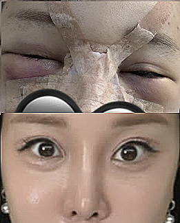 “이명화 은퇴 위기?” 랄랄, 눈밑지·코 재수술 후 ‘사기꾼 아줌마’ 된 사연 (성형 주의사....