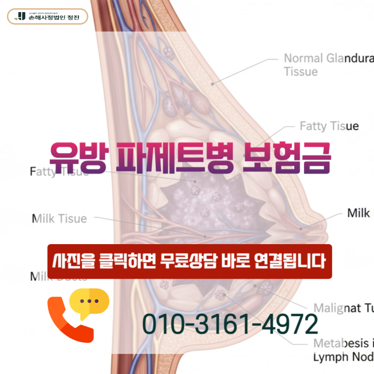  유방 파제트병 보험금, 일반암으로 인정받는 핵심 비결은 무엇일까요?
