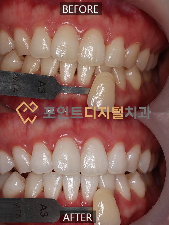 [탕정치과]  답답했던 A3 치아 색상, 이제는 안녕! (미백폭발 코스) / 천안 아산 불당 배방