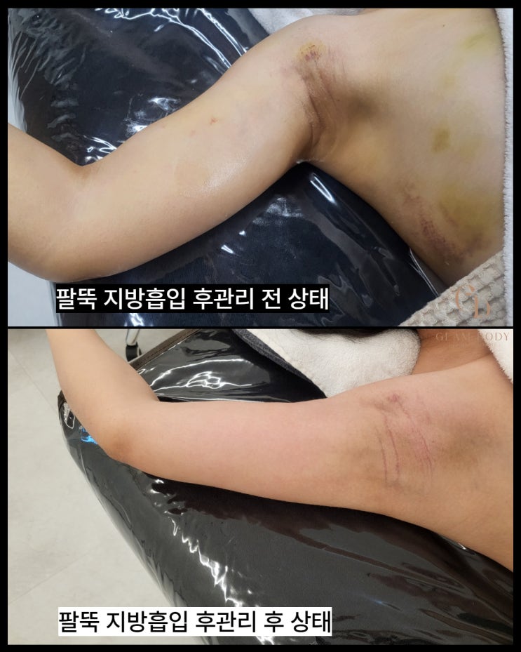  팔뚝 지방흡입 후관리｜만세도 힘들었던 시기에서 자연스러움까지