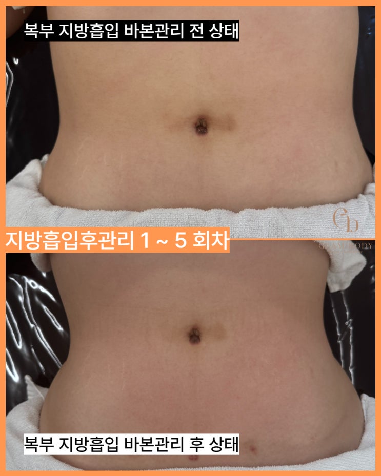  복부 지방흡입 후관리｜육안으로 안 보이는 속바본, 라인이 달라진 이유