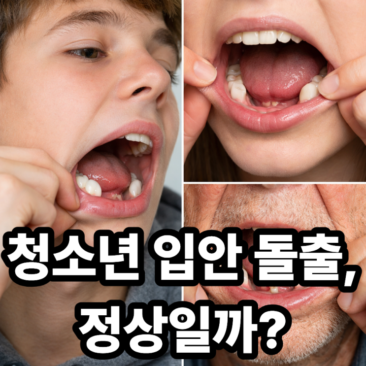  하악골융기 청소년에게도 생길까? 연령별 특징으로 보는 발생 시기