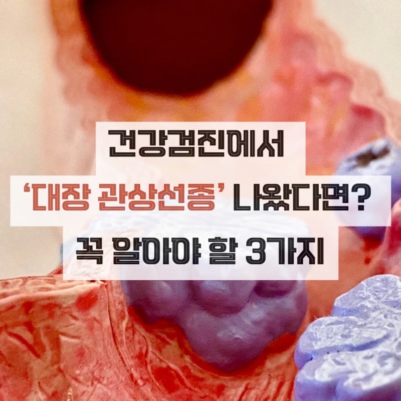대장 관상선종 원인과 치료법 총정리 (용종과의 차이점)