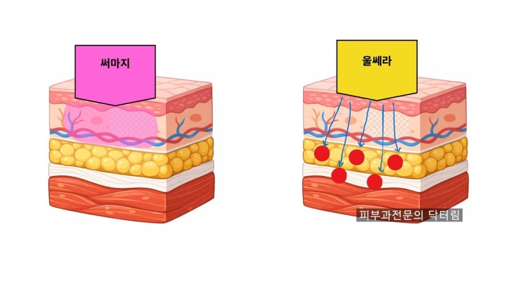 써마지 울쎄라 후 스테로이드 쓰면 효과가 떨어지나요