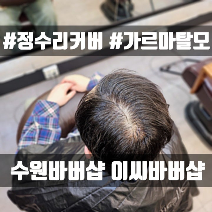  수원 정수리 탈모 링거펌, 30대 남성 모류 갈라짐 해결 후기