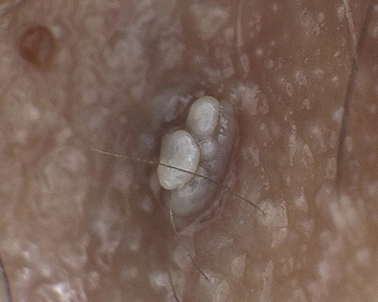 곤지름 치료, 한 번에 제거해도 왜 자꾸 다시 생기는 걸까요?