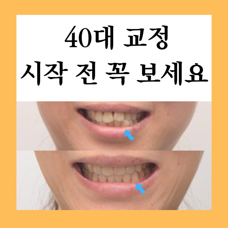  수락산역교정치과, 40대 중년 교정 가능할까요?