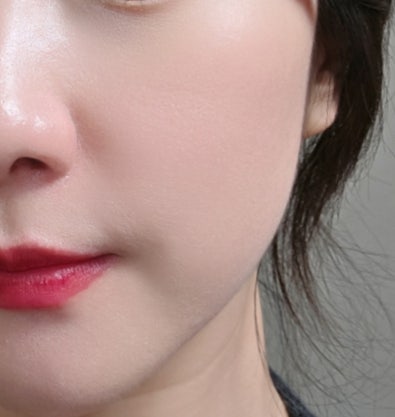 홍대입구역 피부과 리쥬란 물광주사 효과 무통증 후기