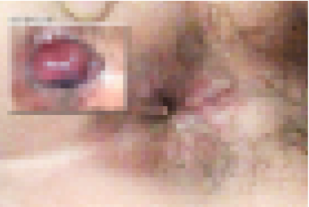 3기 치질 자연치료해서 완치한 후기 (+ 실제 비포 애프터 사진有)
