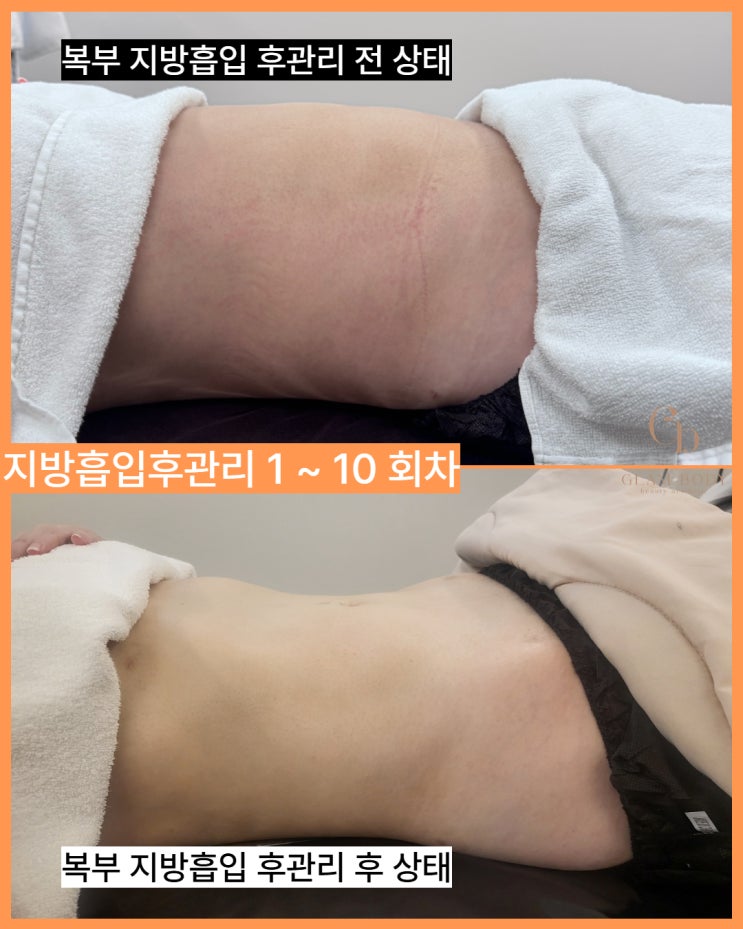  복부 지방흡입 후관리｜붓기 체질이었던 고객님의 회차별 변화 기록