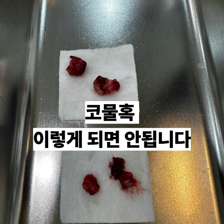  코물혹 치료 수술 없이 가능한 경우와 비용종 비수술 치료 방법