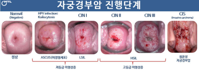 [구미 자궁경부암 국가검진] 경부암 검사 비정형세포 발견 사례