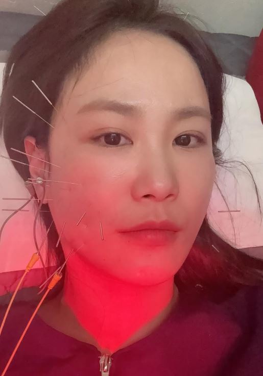  임신 준비 중 김지민, 낙상 사고로 피부 함몰… 얼굴에 침 한가득 치료 근황 “언제 원래대로?” 
