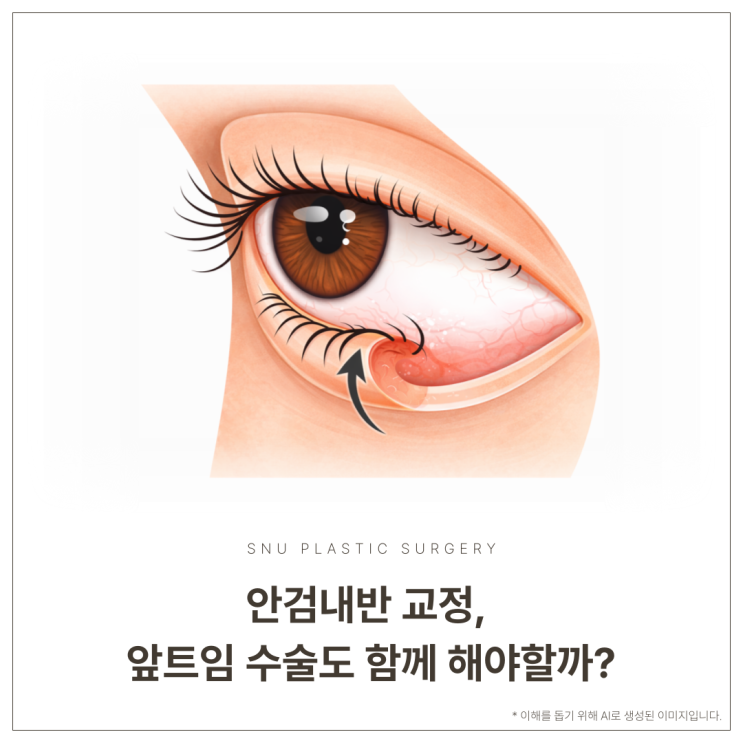  청담 스누성형외과｜안검내반 교정, 앞트임 수술도 함께 해야할까?