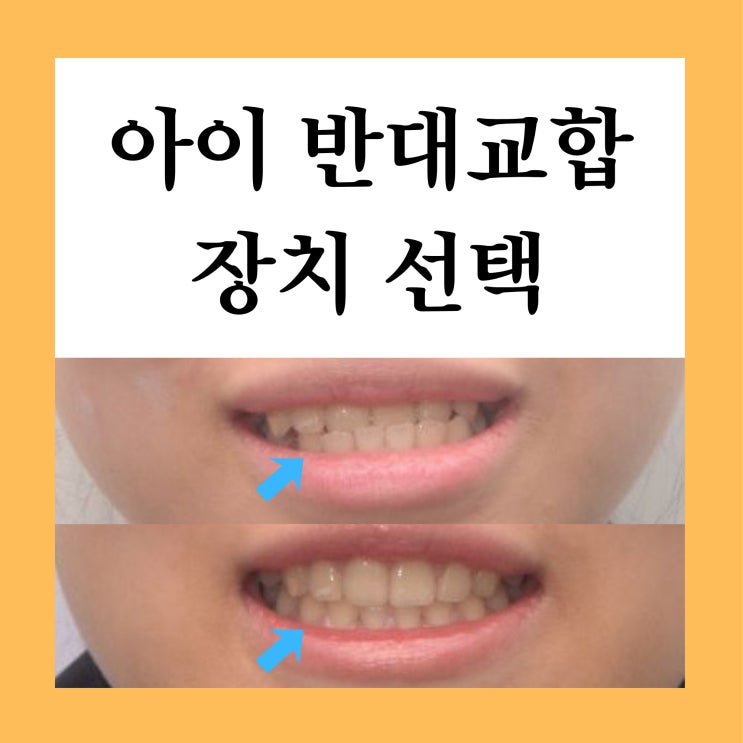  별내교정치과, 소아 반대교합 교정 어떤 장치가 맞을까요?