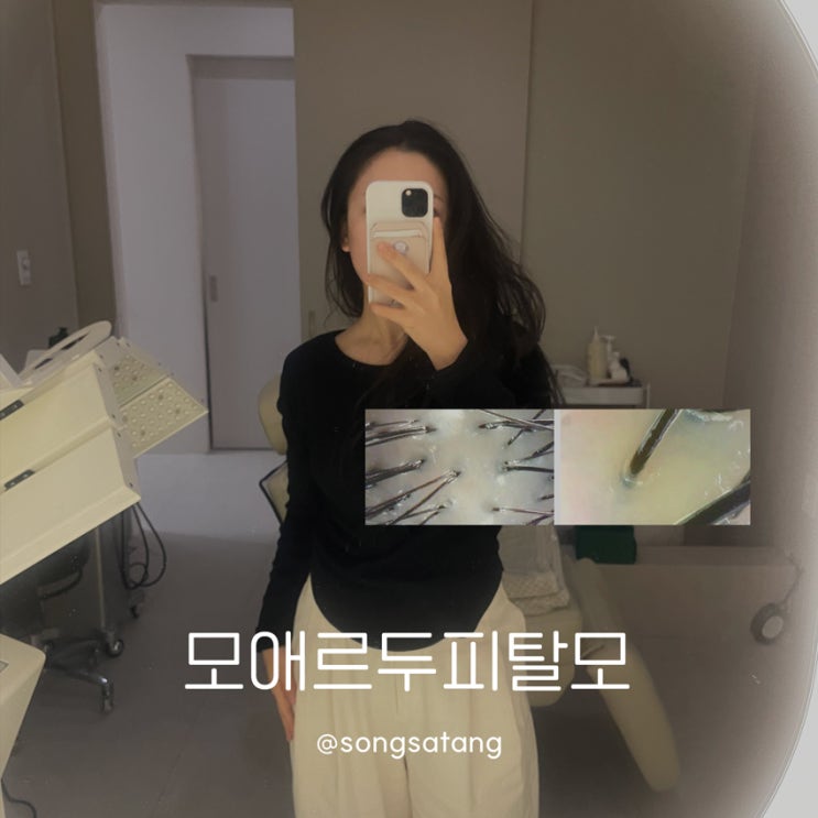  모애르두피탈모 범계점 안양두피관리 전후 차이 효과 있어요