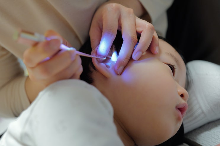  LED 아기 귀지 핀셋 내돈내산 후기, 소아과 대신 집에서 쌍둥이 꽉 막힌 귀지 해결한 썰