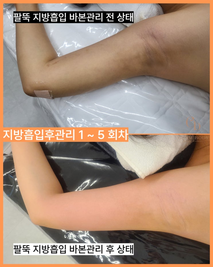  팔뚝지방흡입후관리, 왜 더 단단해진 느낌일까