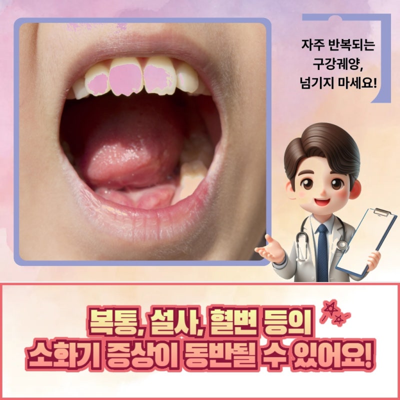 서울 중구 입안 염증이 반복될 때 베체트병검사 치료 방법은?