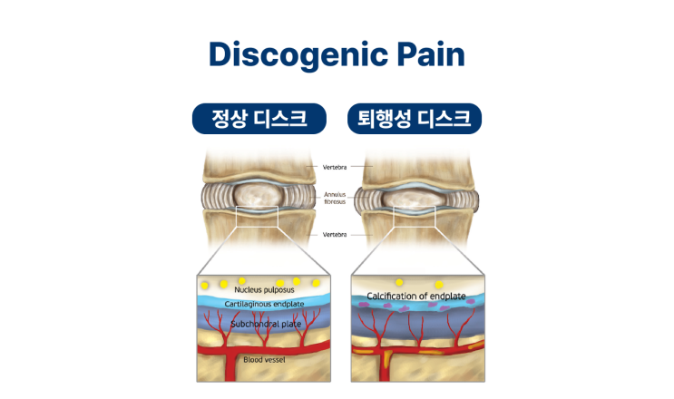  허리가 계속 아픈데 허리디스크는 아니라면? 부산 디스크내장증(추간판 내장증) 허리재활병원
