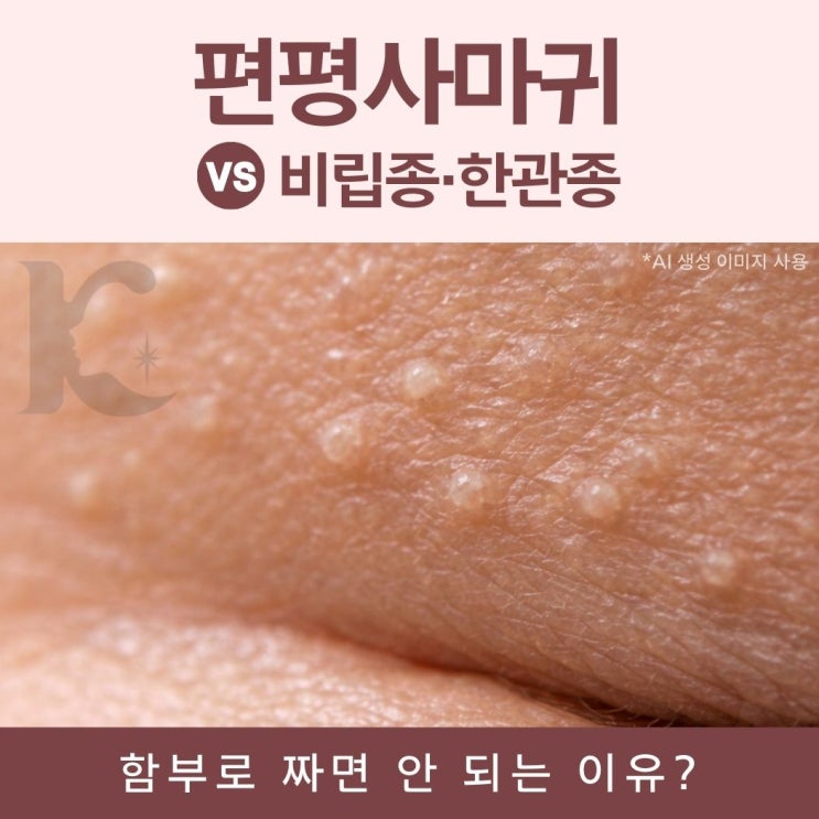  광주편평사마귀 제거 전 비립종 한관종 증상과 원인 비교 수완지구피부과 기준