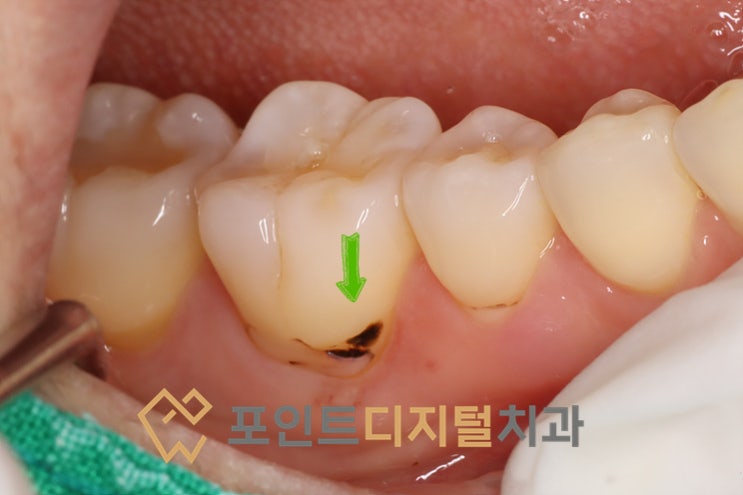 [탕정치과]  치경부 우식 레진 재치료 / 천안 아산