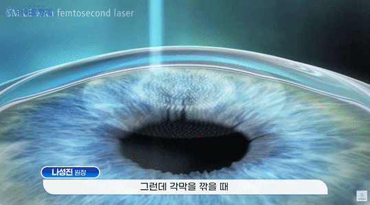  라식 후 빛번짐이 생기는 사람 vs 안 생기는 사람