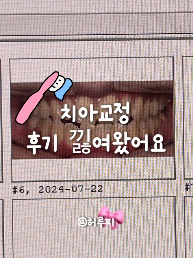나의 교정 일기, 개방교합 교정 전후 비교