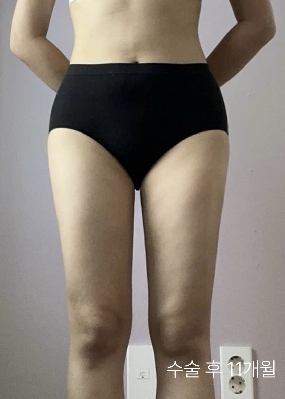  허벅지지방흡입당일 통증, 붓기, 두께 변화 등 총정리