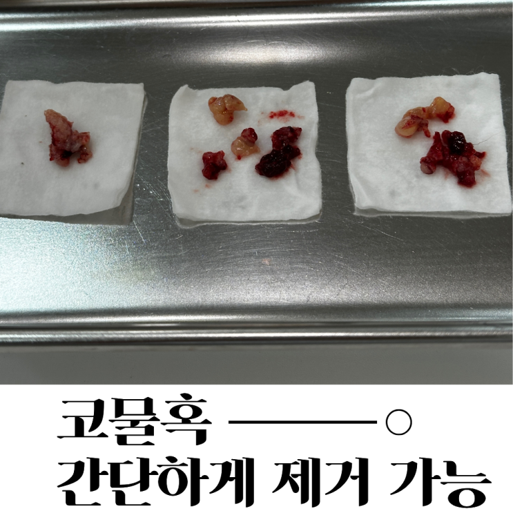 수술하지 않고 코물혹을 치료할 수 있는 방법