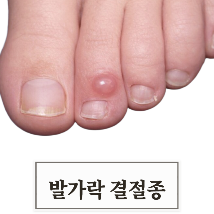  결절종 비수술 치료 가능한가요? 환자들이 가장 많이 묻는 질문 QNA