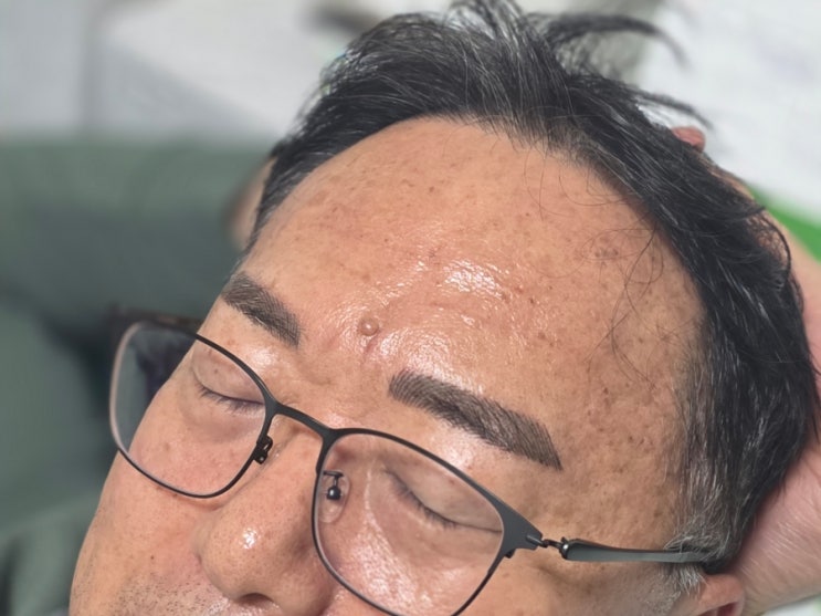  청담 피부과 쥬브젠 자가진피재생술로 부모님 이마주름, 미간주름 고민 해결한 찐후기