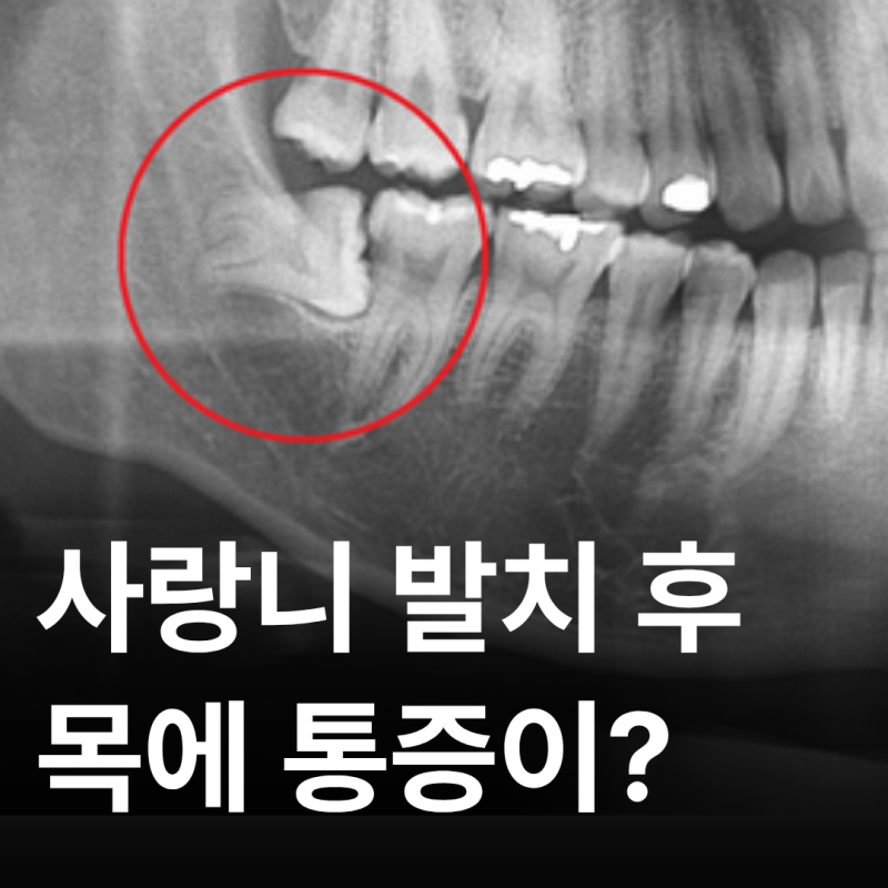 사랑니 발치 후 목통증, 인후통 정상? 원인과 대처