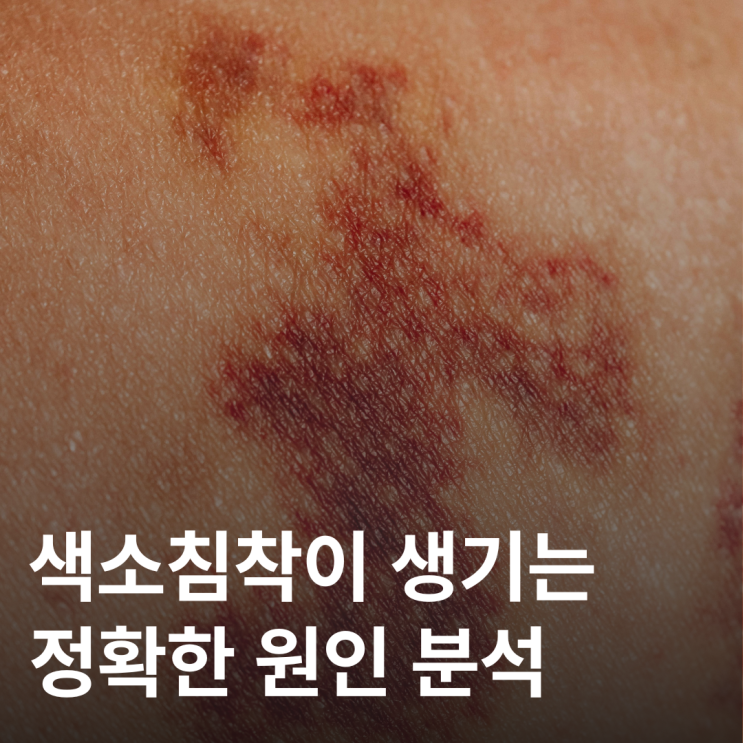  색소침착은 왜 생길까? 피부가 어두워지는 의학적 이유