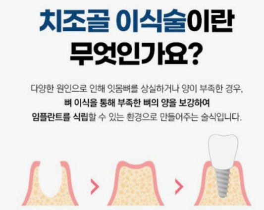 임플란트 치조골 이식술, 수술비 받으셨나요?