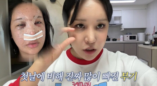 랄랄 코 성형 수술만 3번째 놀라운 회복력 보여준 유튜버 근황
