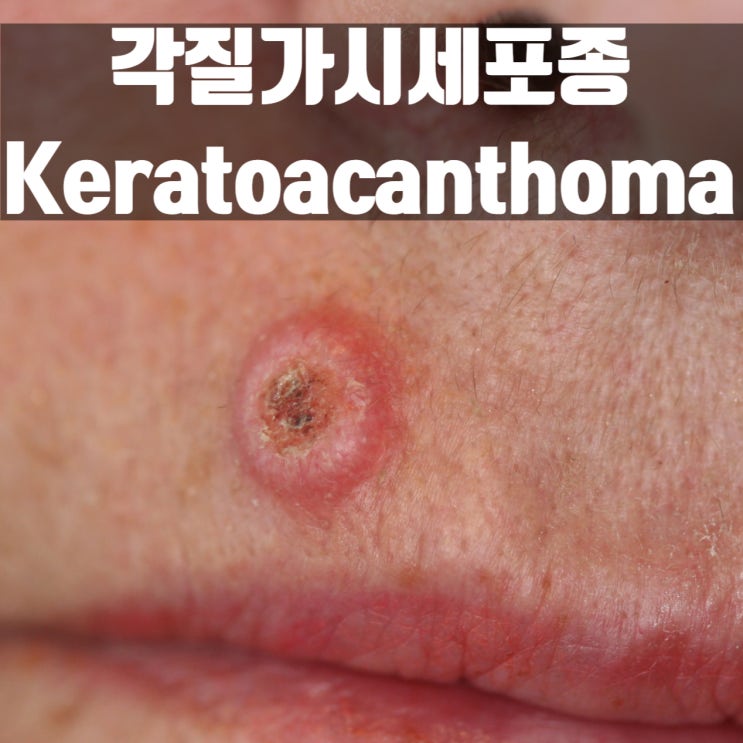  피부에 갑자기 발생한 화산형태의 종양, 각질가시세포종(Keratoacnathoma)